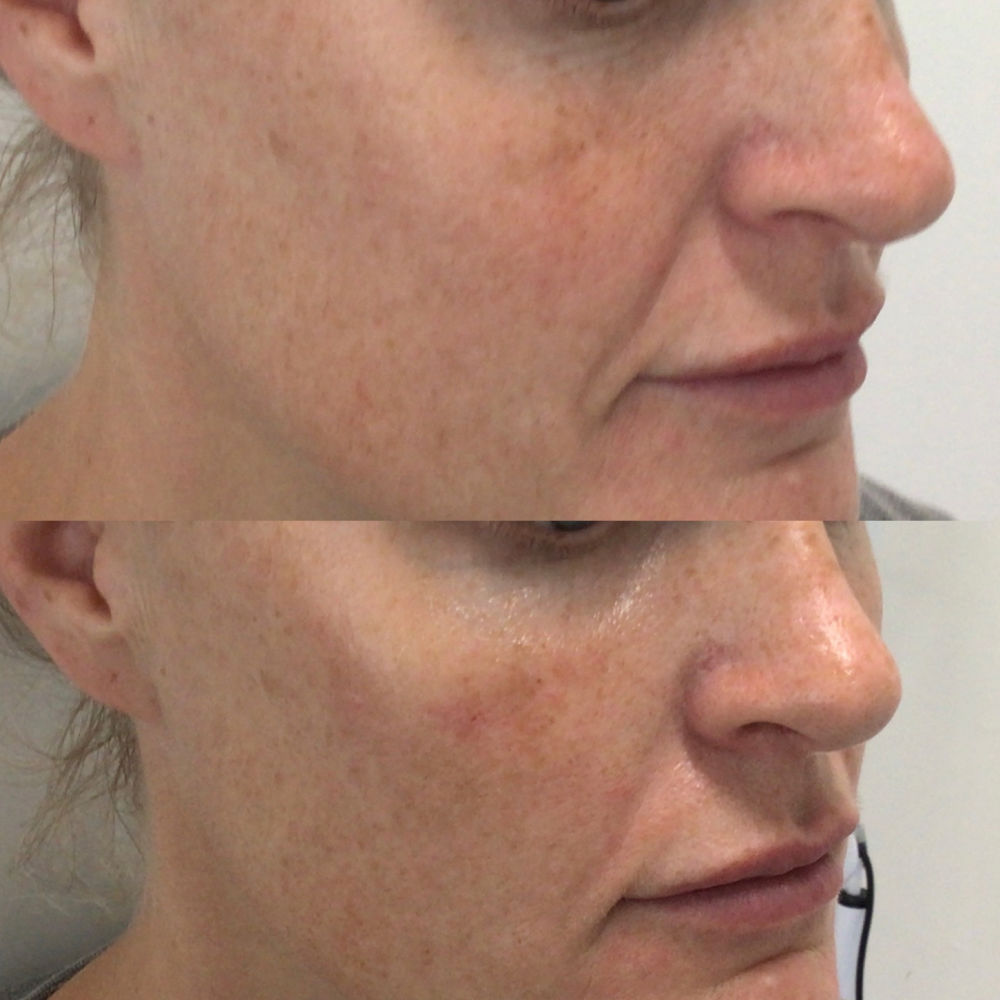 Dermal cheek fillers - Darwen Aesthetics