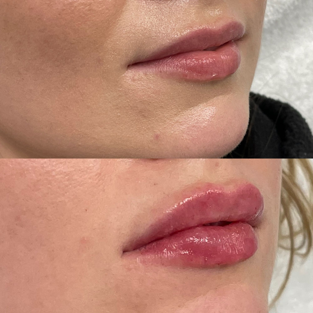 natural lip filler