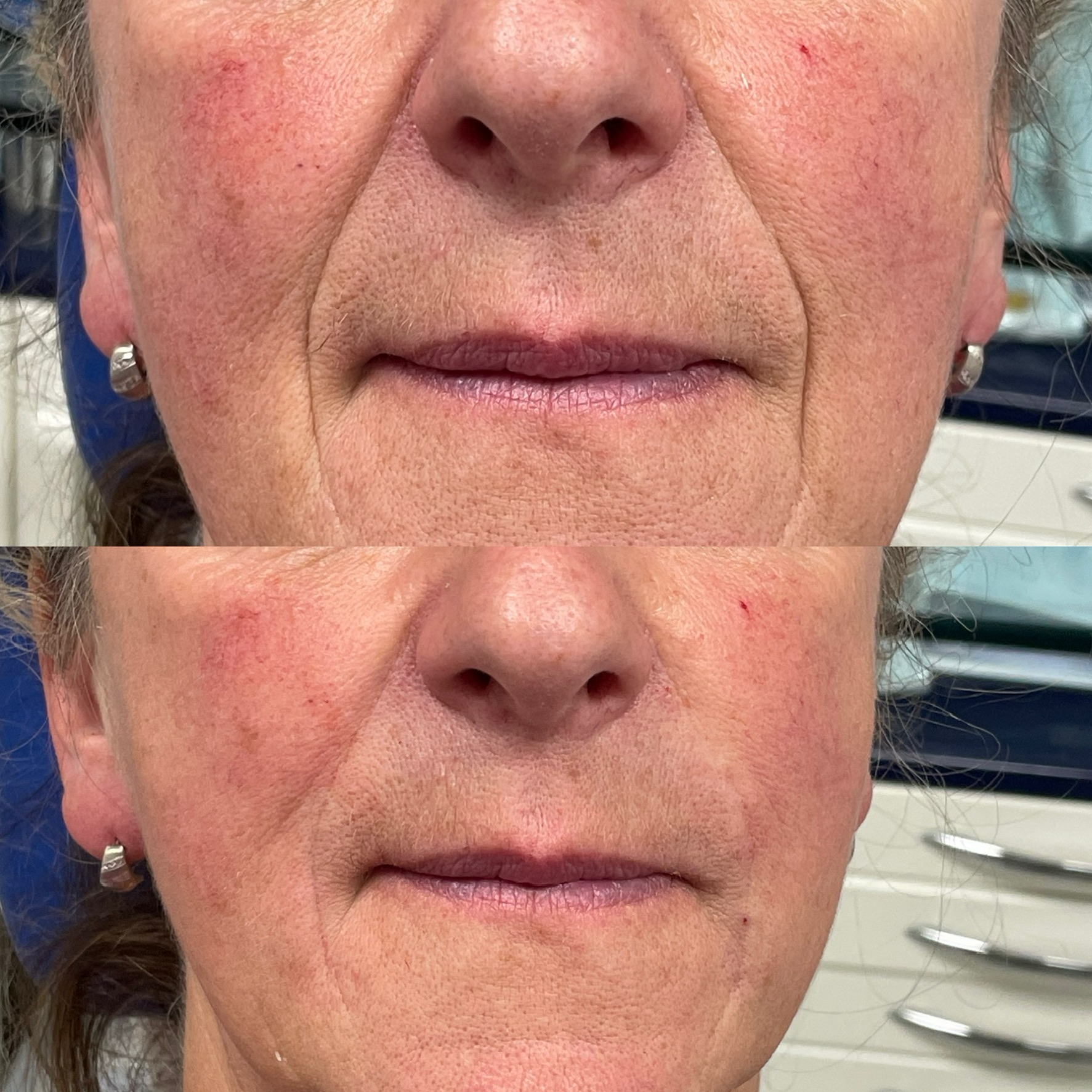 nasolabial folds filler - Darwen Aesthetics