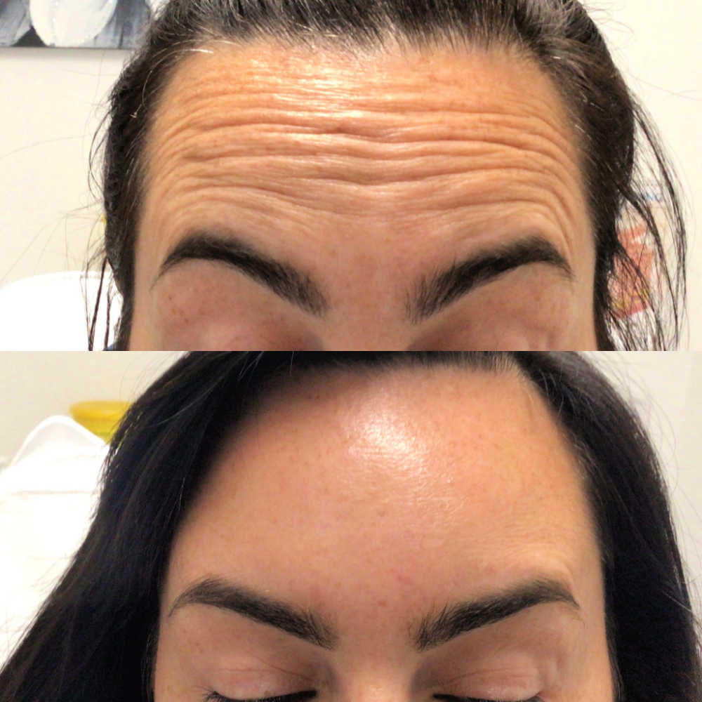 Anti Wrinkle Treatment - Botox Blackburn