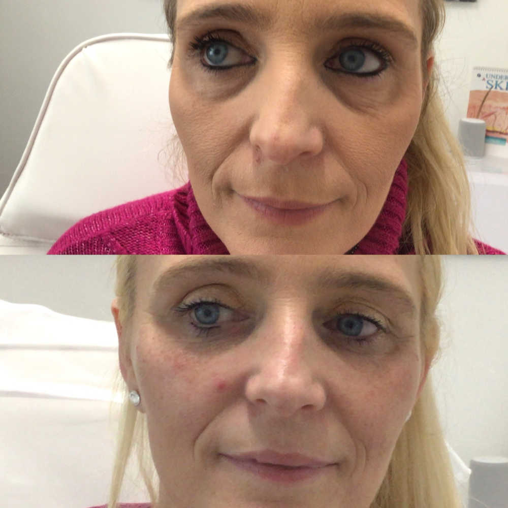 Tear Trough Filler Under Eye Treatment Darwen Blackburn