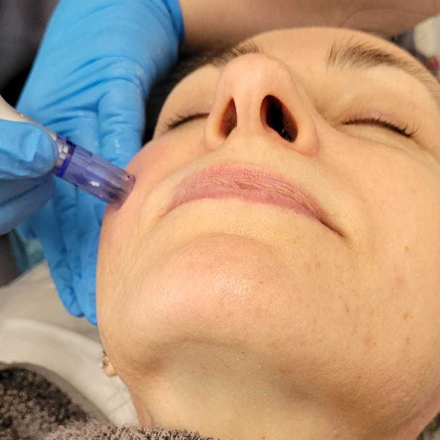 Micro Needling Treatment - Darwen Aesthetics near Blackburn